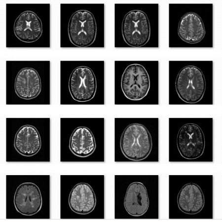 پروژه تشخیص تومور مغزی توسط مدل مخفی مارکوف با متلب