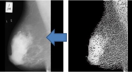 پروژه شناسایی تصاویر ماموگرافی سرطان پستان با شبکه عصبی