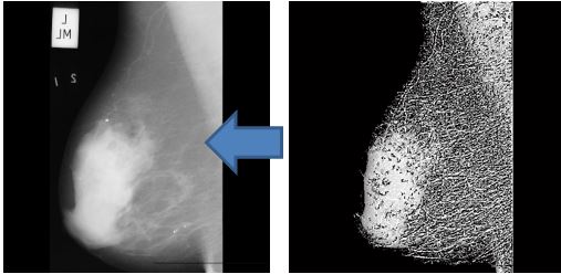 پروژه شناسایی تصاویر ماموگرافی سرطان پستان با شبکه عصبی