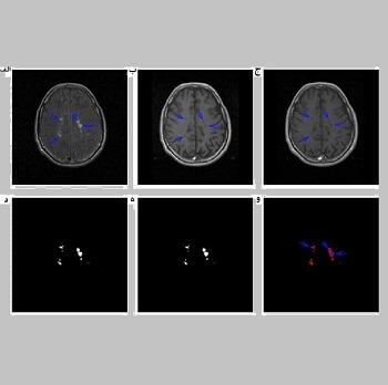 تشخیص ضایعه MS در تصاویر MRI مغز با استفاده از پردازش تصویر و شبکه عصبی مصنوعی با متلب