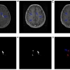 تشخیص ضایعه MS در تصاویر MRI مغز با استفاده از پردازش تصویر و شبکه عصبی مصنوعی با متلب