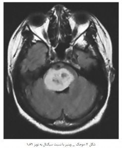 شبیه سازی کاهش نویز تصاویر MRI با استفاده از فیلتر وینر با متلب