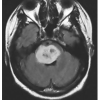 شبیه سازی کاهش نویز تصاویر MRI با استفاده از فیلتر وینر با متلب