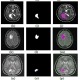 شبیه سازی مقاله تقسیم بندی تصاویر MRI برای تعیین تومور مغزی توسط الگوریتم ژنتیک با متلب