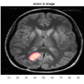 شبیه سازی مقاله تقسیم بندی تصاویر MRI برای تعیین تومور مغزی توسط الگوریتم ژنتیک با متلب