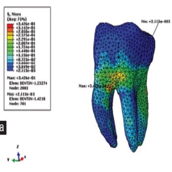 مدلسازی و تحلیل دندان با آباکوس