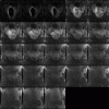 شبیه سازی حذف نویز از تصاویر پزشکی توسط فیلتر گابور با متلب