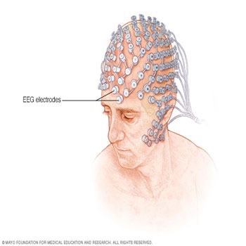 ترجمه تشخیص بهبود یافته تأخیر های کوتاه در برانگیختگی موتوری در  نرم افزار رابط رایانه و مغز EEG حلقه بسته
