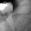 پروژه تشخیص پوسیدگی دندان به کمک پردازش تصویر با متلب