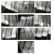 پروژه تشخیص پوسیدگی دندان به کمک پردازش تصویر با متلب
