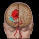 تحقیق سکته مغزی و مشکلات عروقی مغز